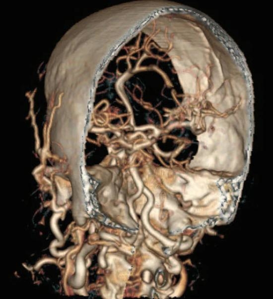 虚拟尸检通过CT血管造影呈现的脑动脉系统