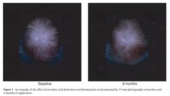 烟酸衍生物六个月的生发效果还是不错的