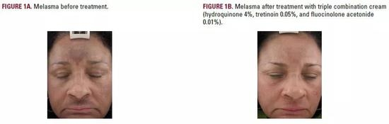 　美白产品效果举例（对苯二酚、维甲酸、氟辛醇酮丙酮）