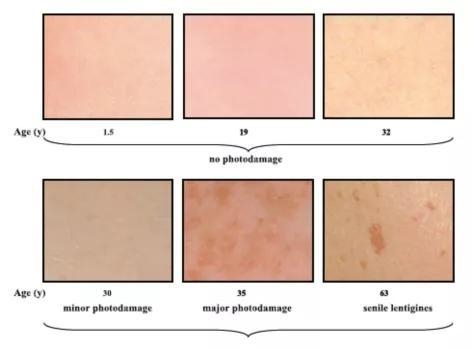 　　不同年龄显示出不同的色素沉着模式
